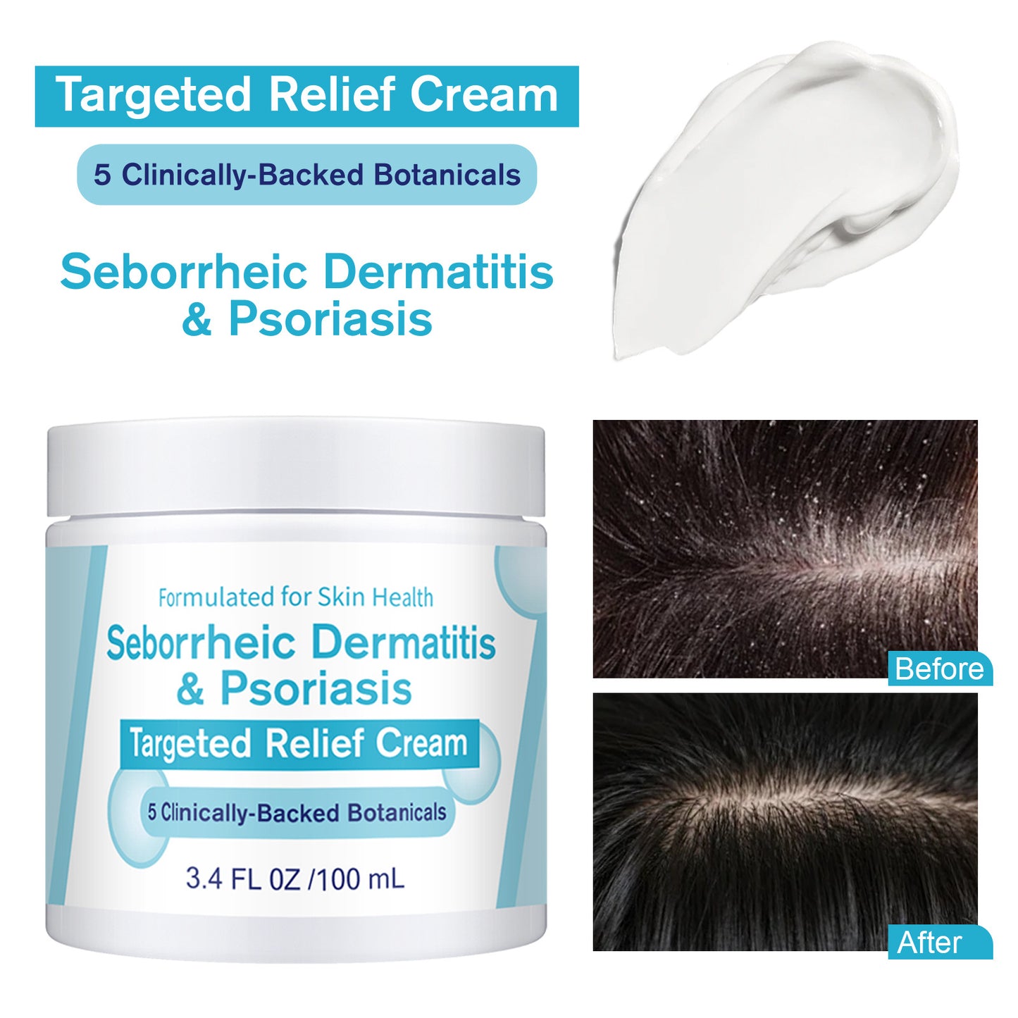 Seborrheic Dermatitis Skin Cream