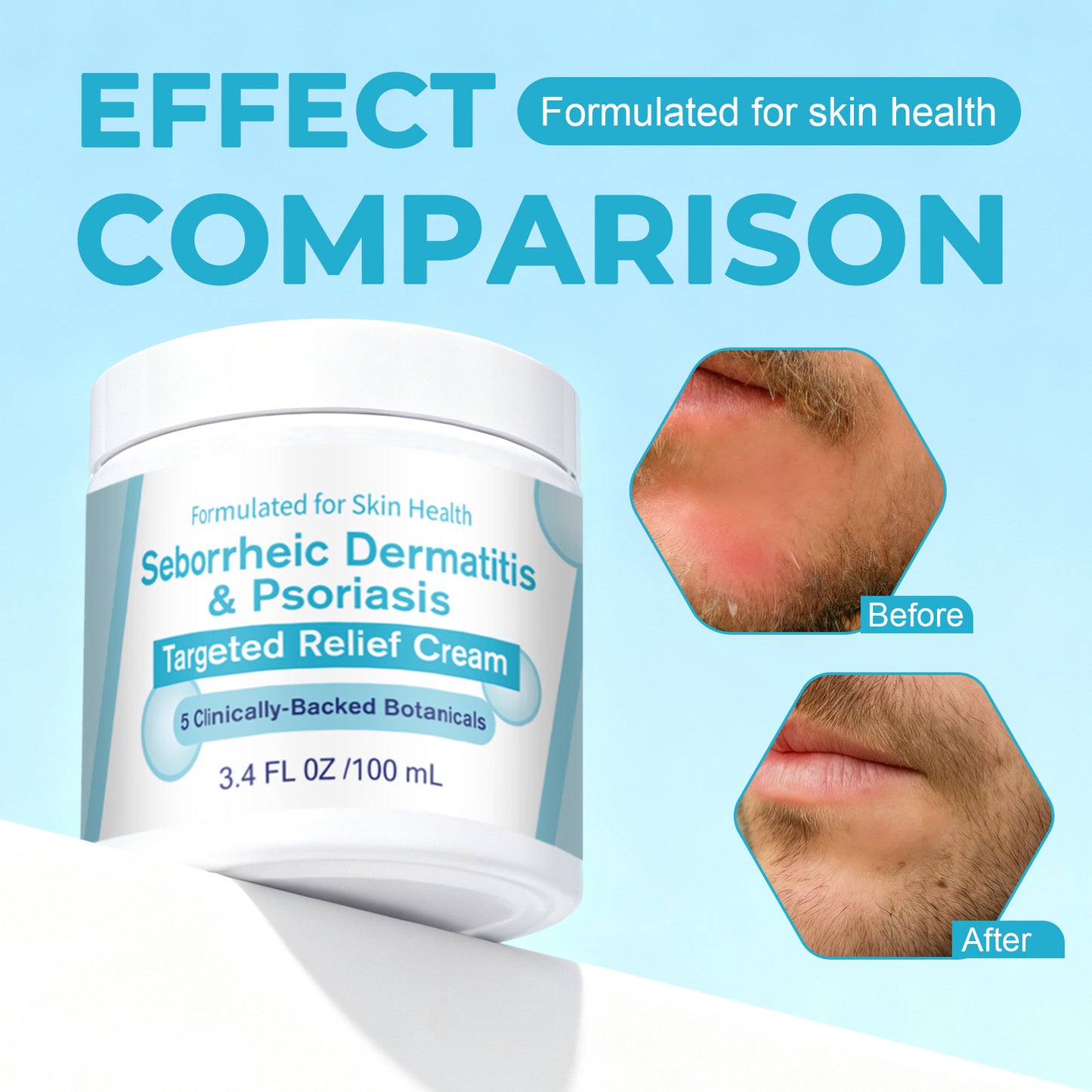 Seborrheic Dermatitis Skin Cream